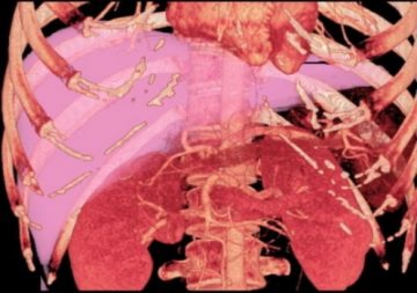 A mathematical method to better allocate donated livers in transplantations